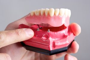 Dental implant modal 