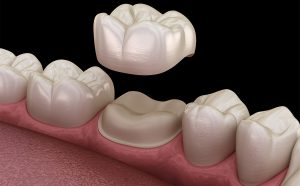 Dental Crown Process in Bedford TX Area 