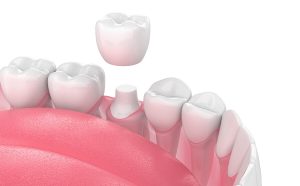 Tooth Crown Replacement in Bedford TX Area 