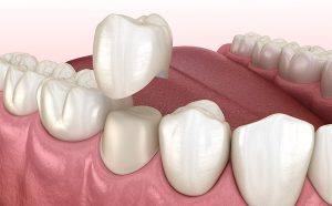 Dental Crown Restoration in Bedford TX Area 