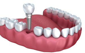 Same Day Teeth Implants in Bedford TX Area 
