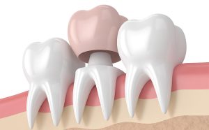 Why do I Need a Dental Crown in Bedford TX Area 