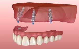 All-On-4 Dental Implants in Fort Worth TX Area 