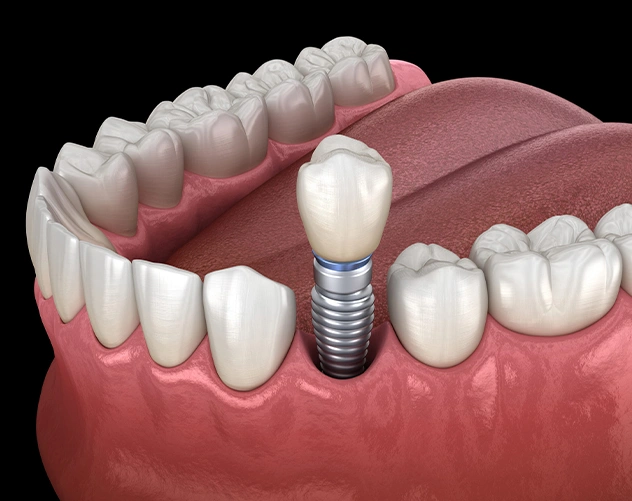 Dental Implants Bedford