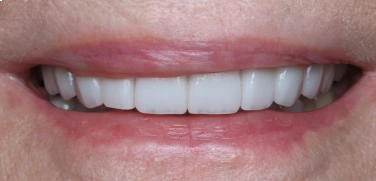 After Smile Transformation