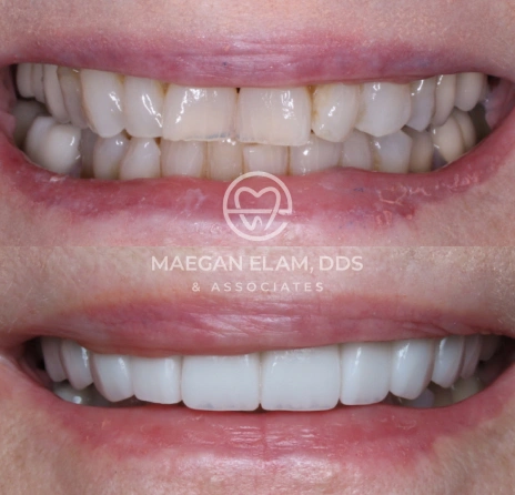 Smile transformation at Maegan Elam, DDS and Associates