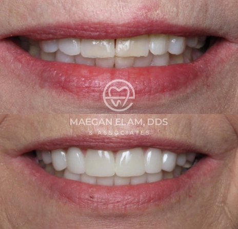 Smile Transformation Before -After