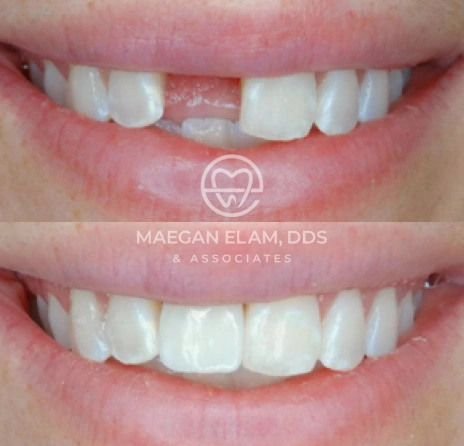 Teeth Gap Smile Transformation