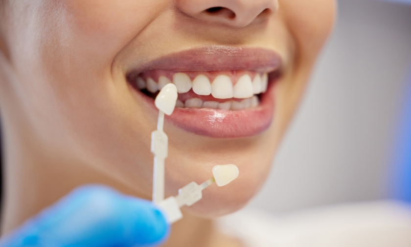 get straighter teeth with veneers