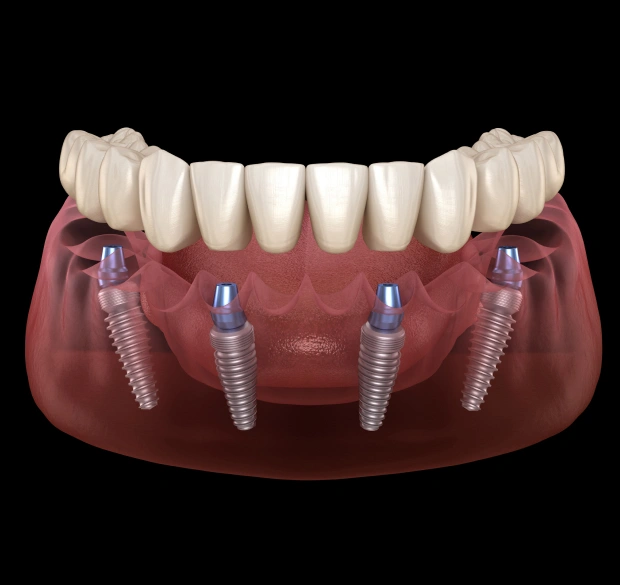 3D illustration of All-on-4 dental implants for full-arch tooth replacement in Bedford, TX