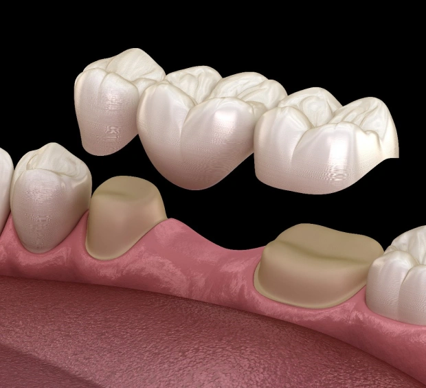 dental bridge restoring missing teeth for dental care in Bedford, TX