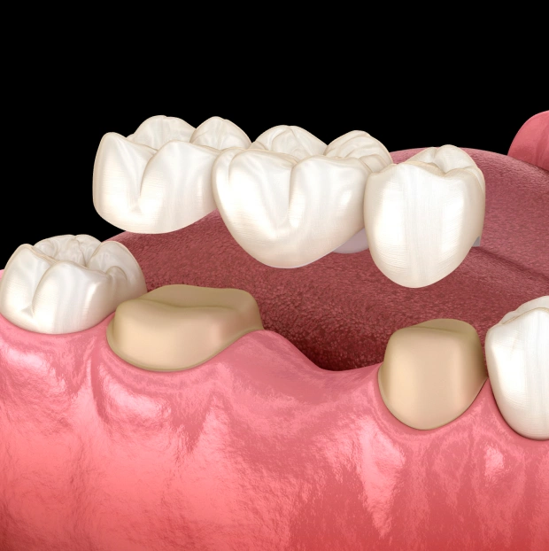 3D illustration of dental crowns being placed over prepared teeth in Bedford, TX dental office