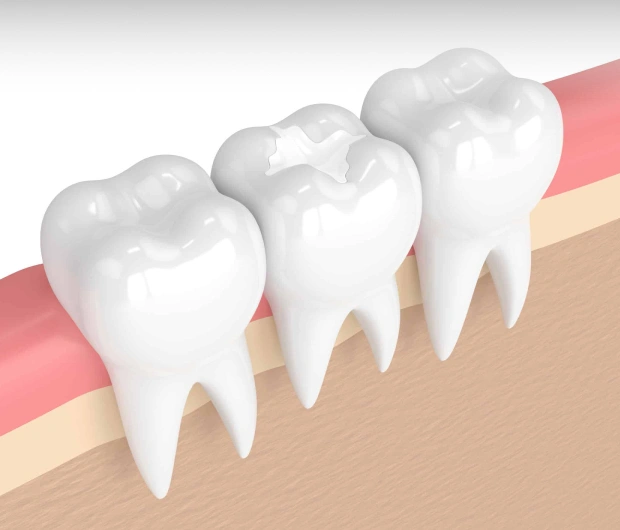 3D illustration of a tooth with dental filling showing cavity restoration in Bedford, TX dental care