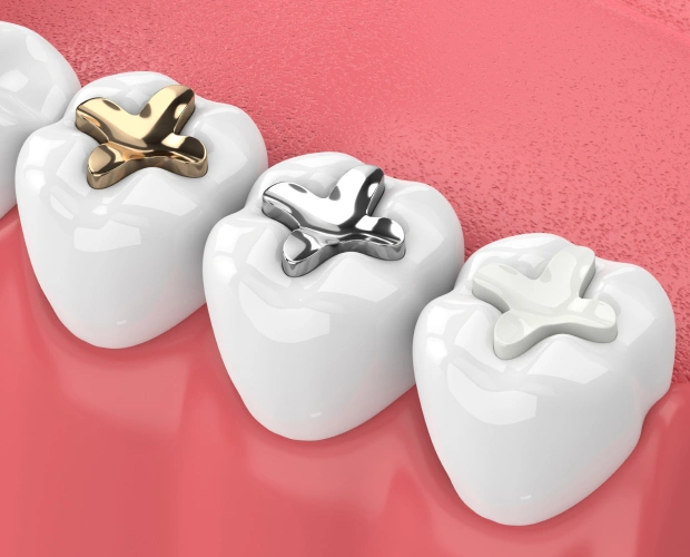 Illustration of three teeth with different colored dental fillings showing metal-free restorations in Bedford